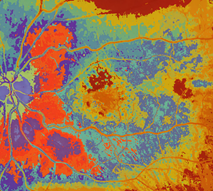 Picture of macular degeneration scan of an eyeball